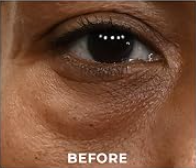 UNDER-EYE BAGSS — BEFORE