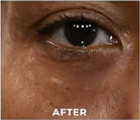 UNDER-EYE BAGSS — AFTER