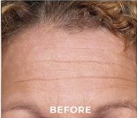 Forehead lines — BEFORE