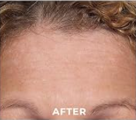 Forehead lines — AFTER
