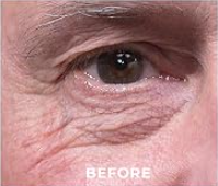 FINE LINES & WRINKLES — BEFORE