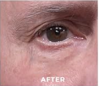 FINE LINES & WRINKLES — AFTER